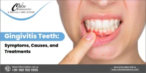 Read more about the article Gingivitis : Symptoms, Causes, And Treatments