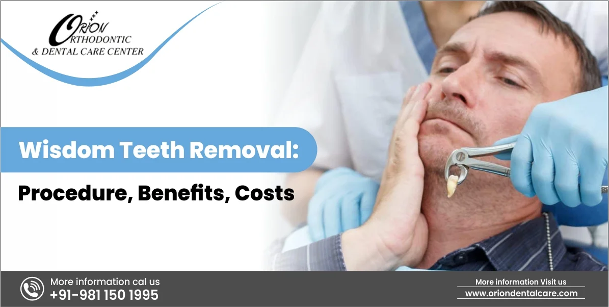 You are currently viewing Wisdom Teeth Removal: Procedure, Benefits, Costs