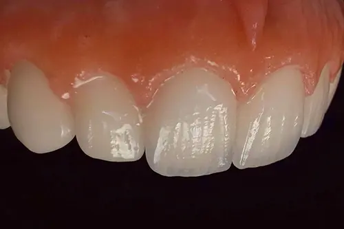 Close-up of natural-looking porcelain veneers