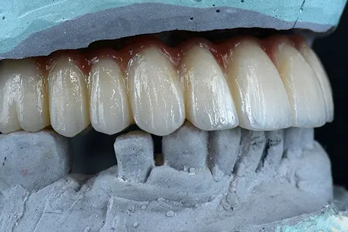 A full row of implant-supported teeth on a stone model