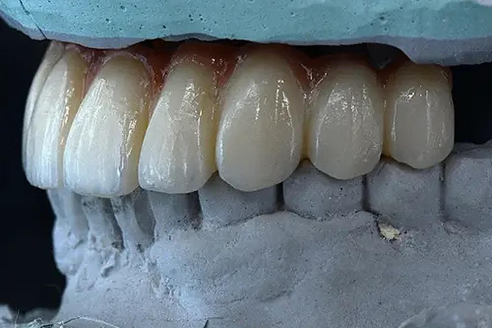 A row of custom-made front teeth on a stone model, used to plan and explain a fixed set of teeth on implants