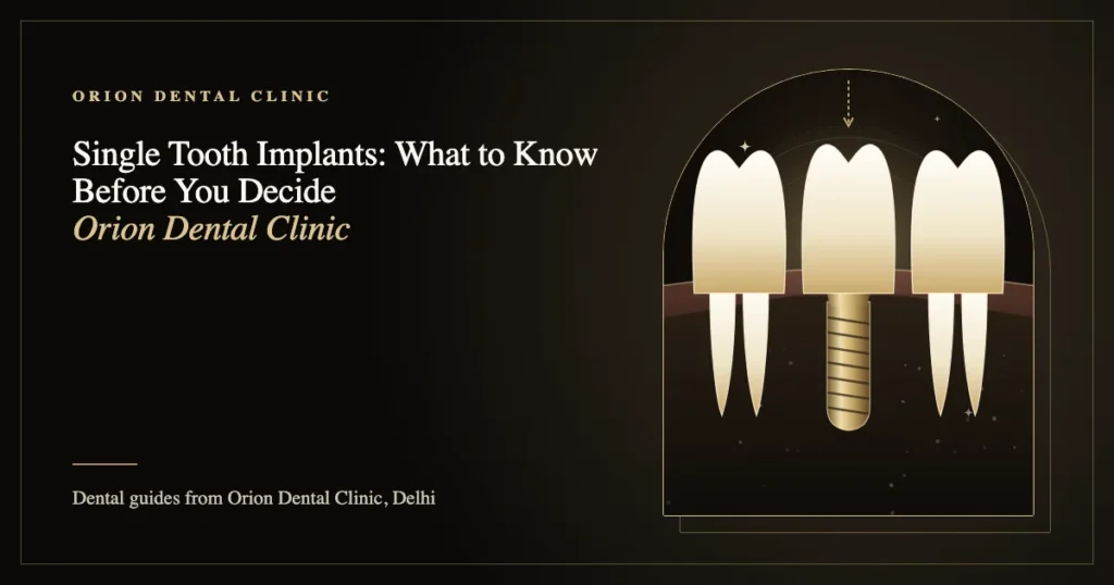 Single Tooth Implants: What to Know Before You Decide | Orion Dental Clinic guide