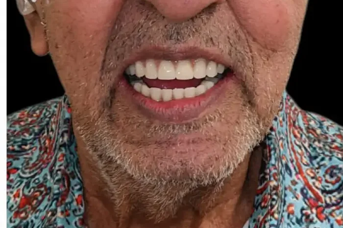 After: a full set of teeth is visible.