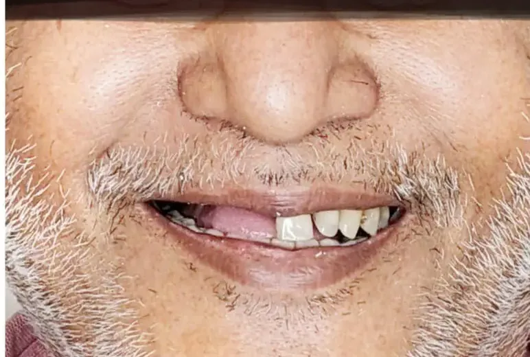 Before: an upper front tooth is missing.